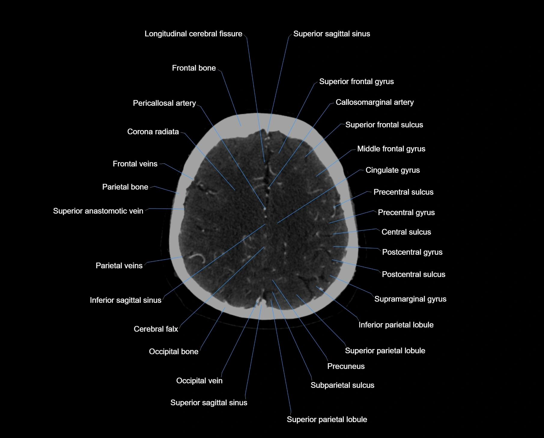 CT scan brain axial labelled cross sectional anatomy image-img-000052.webp